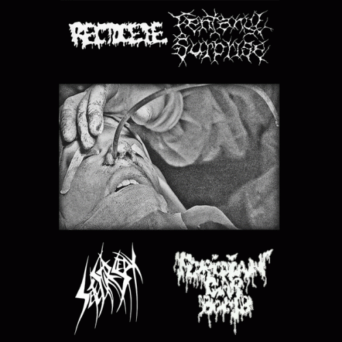 Rectocele : 4 Way Split